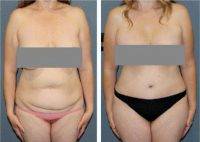 Liposuction, Breast Augmentation, Tummy Tuck