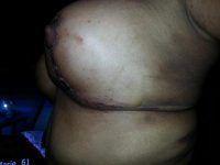 Doctor Ajaya Kashyap, MD, New Delhi Plastic Surgeon Mom Tummy Tuck Patient