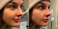 18-24 year old woman treated with Nonsurgical Nose Job, Dermal Fillers
