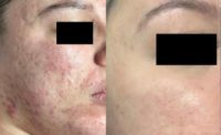 25-34 year old woman treated with Vivace