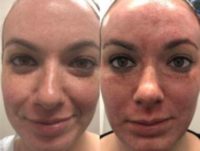 25-34 year old woman treated with Vampire Facial