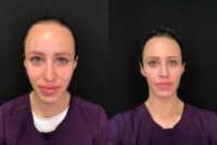 25-34 year old woman treated with Vampire Facelift