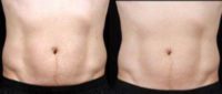 35-44 year old man treated with SculpSure
