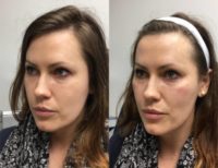 35-44 year old woman treated with Restylane Lyft