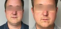 35-44 year old man treated with Kybella