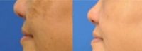 45-54 year old woman treated with Melasma Treatment
