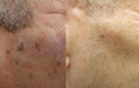 45-54 year old man treated with Fractional Laser