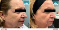 55-64 year old woman treated with CO2 Laser