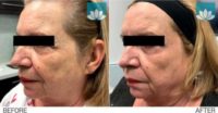 55-64 year old woman treated with CO2 Laser
