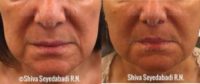 65-74 year old woman treated with Sculptra Aesthetic / Liquid Facelift