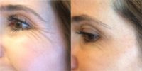 45-54 year old woman treated with Botox for crows feet