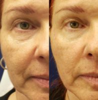 Woman treated with Skin Rejuvenation radiofrequency