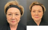 65-74 year old woman treated with Skin Rejuvenation, Neck Lift
