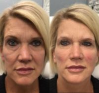 55-64 year old woman treated with Voluma