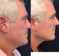 CoolSculpting for Chin