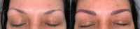 25-34 year old woman treated with Microblading