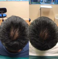 55-64 year old man treated with PRP for Hair Loss