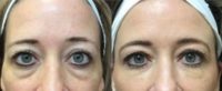 35-44 year old woman treated with Restylane