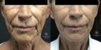 55-64 year old woman treated with Vivace