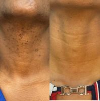 35-44 year old woman treated with Laser Hair Removal