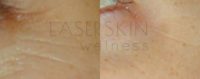 Treated with Skin Rejuvenation