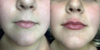 18-24 year old woman treated with Lip Fillers