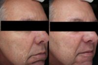 65-74 year old man treated with Microdermabrasion