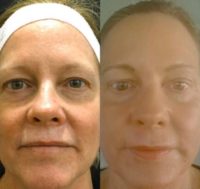 Woman treated with Laser Treatment
