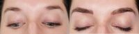 25-34 year old woman treated with Microblading