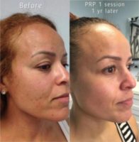 35-44 year old woman treated with PRP Injections