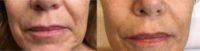 55-64 year old woman treated with Restylane