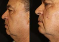 55-64 year old man treated with Nonsurgical Facelift