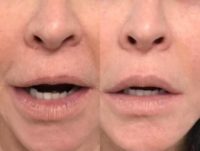 Corrective work: 45-54 year old woman treated with Lip Augmentation