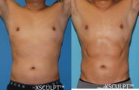 35-44 year old man treated with Vaser Liposuction