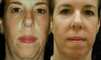 woman treated with Laser Resurfacing