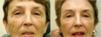 Woman treated with Laser Resurfacing