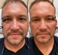 Man treated with Restylane