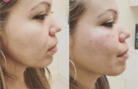 Nonsurgical cheek augmentation and lift