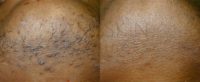 Treated with Laser Hair Removal