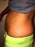 Dr Jeremy A. Benedetti Tummy Tuck Results Image