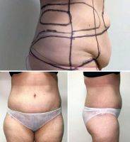 Before And After Photos Of Mommy Makeover Surgeries