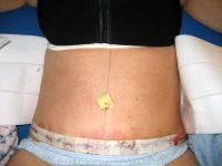 Breast Augmentation And Tummy Tuck After Birth