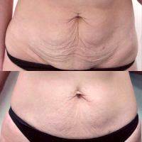 Before And After Photos Of Mommy Makeover Procedure