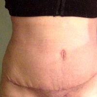 Dr Farbod Esmailian Breast Augmentation And Tummy Tuck