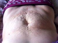 Dr. Sumer Daiza Tummy Tuck Lipo And Breast Augmentation Photos Result