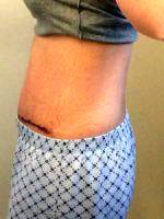 After Tummy Tuck At Z Medical Aesthetics
