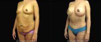 Doctor Eric Sadeh, MD, Manhattan Plastic Surgeon - 40 Woman Treated With Mommy Makeover