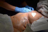 Doctor Kenneth Bermudez, MD, FACS, San Francisco Plastic Surgeon Mummy Tummy Tuck Picture