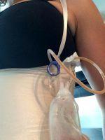 Mom Tummy Tuck By Dr N. Bill Aydin, MD, Paramus Plastic Surgeon