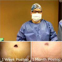 Mom Tummy Tuck Results By Doctor Josue Lara, MD, Mexico Plastic Surgeon